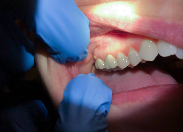 Best Emergency Dental Extractions in Bushland, TX